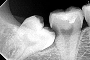 x-ray showing impacted wisdom tooth causing decay in adjacent tooth