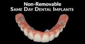 Teeth in a day by All On 4 Dental Impant