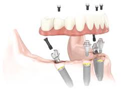 All on 4 Dental Implant Prosthesis