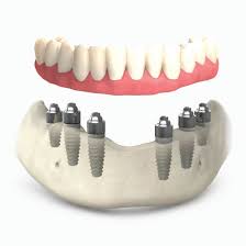 All on 6 dental implant prosthesis