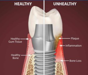 Differentiate between healty and unhealthy dental implant 