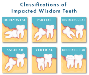 Wisdom tooth positions