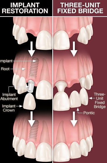 Comparision of Dental Implant & Dental Bridge