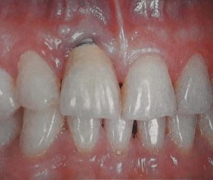 Gum loss from dental implant