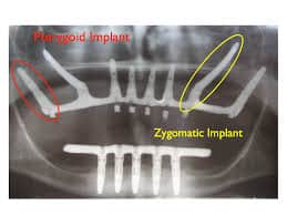 opg showing zygoma & Pterygoid implants