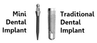 mini vs regular dental implants