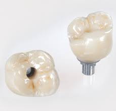 Screw retained Dental Implant Crown