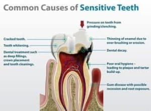 Causes of tooth sensitivity