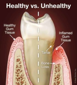 Comparision of healthy and diseased gums