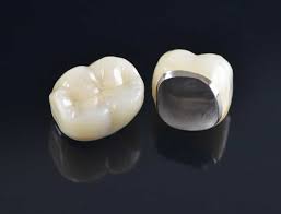 porcelain fused to metal teeth caps