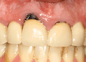 Tooth decay under dental cap