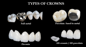 Types of dental crown