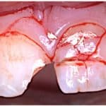 Teeth Injury