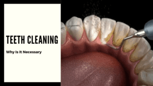 Teeth Cleaing