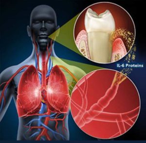 Relation between gum infection and heart diseases