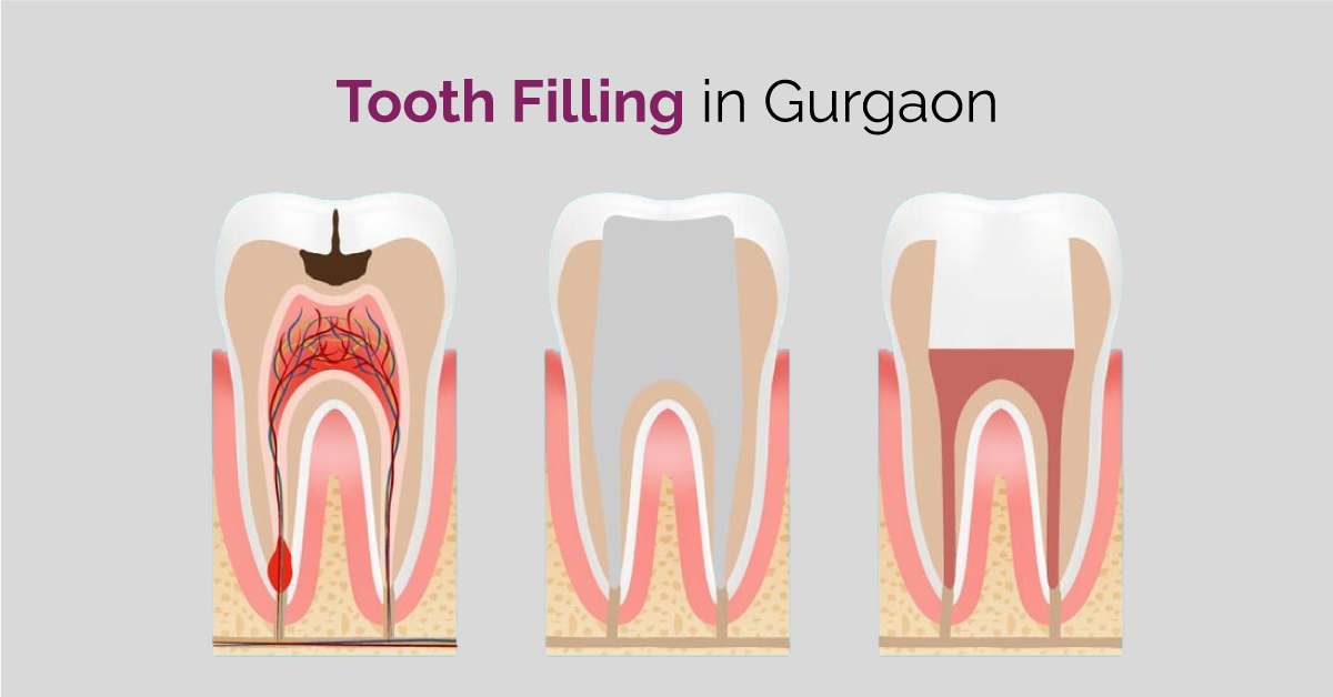 Tooth filling dental clinic in gurgaon