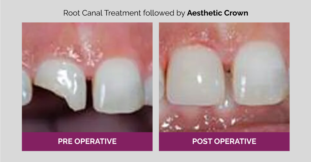 root canal treatment clinic in gurgaon