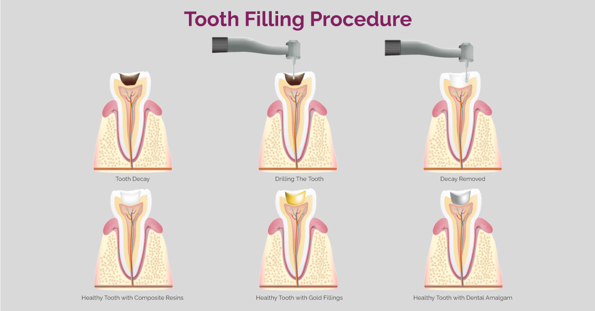 tooth-filling-dental-care-clinic-gurgaon