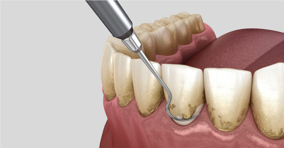 Scaling will damage the tooth surface