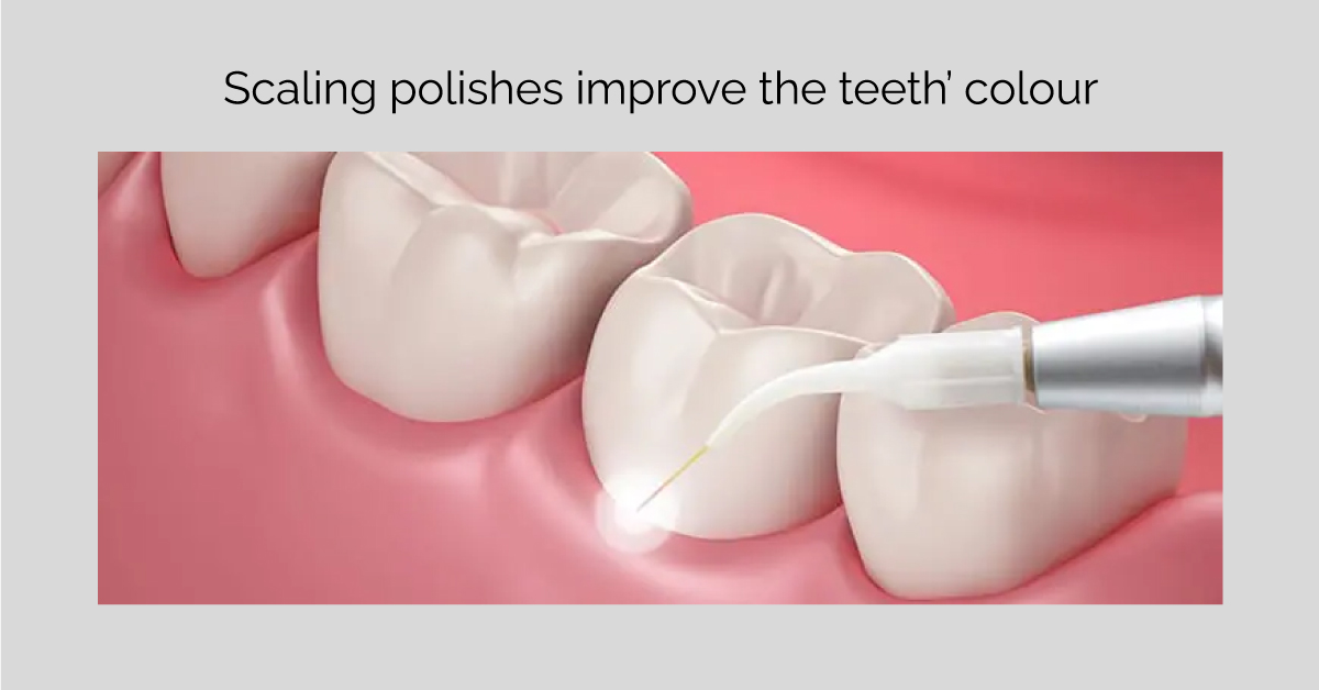 Scaling polishes improve the teeth color