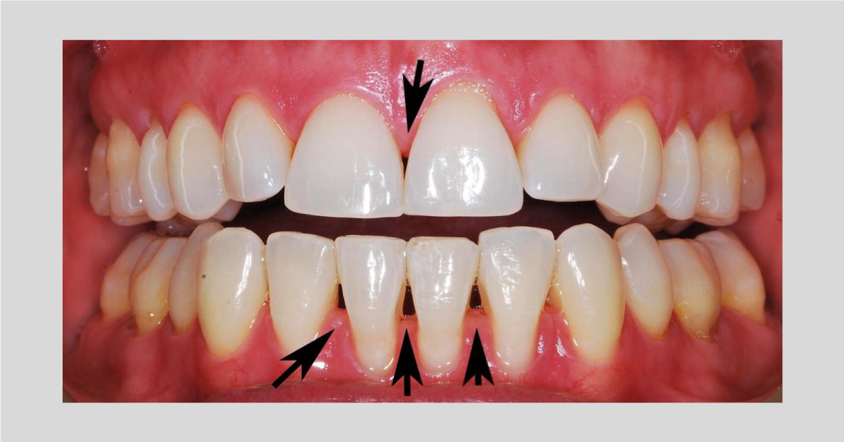 Scaling leads to a gap between the teeth