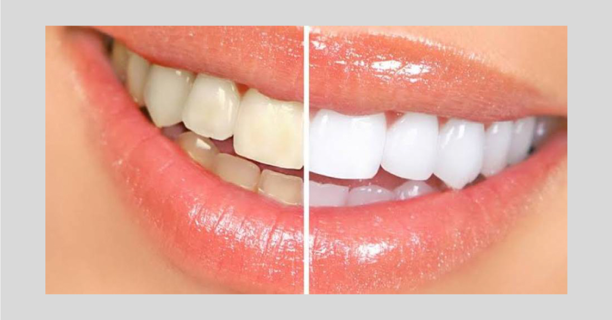 Scaling is a type of cosmetic procedure