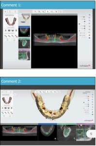 Dental Implant planning for all on 4 with guided implant surgery