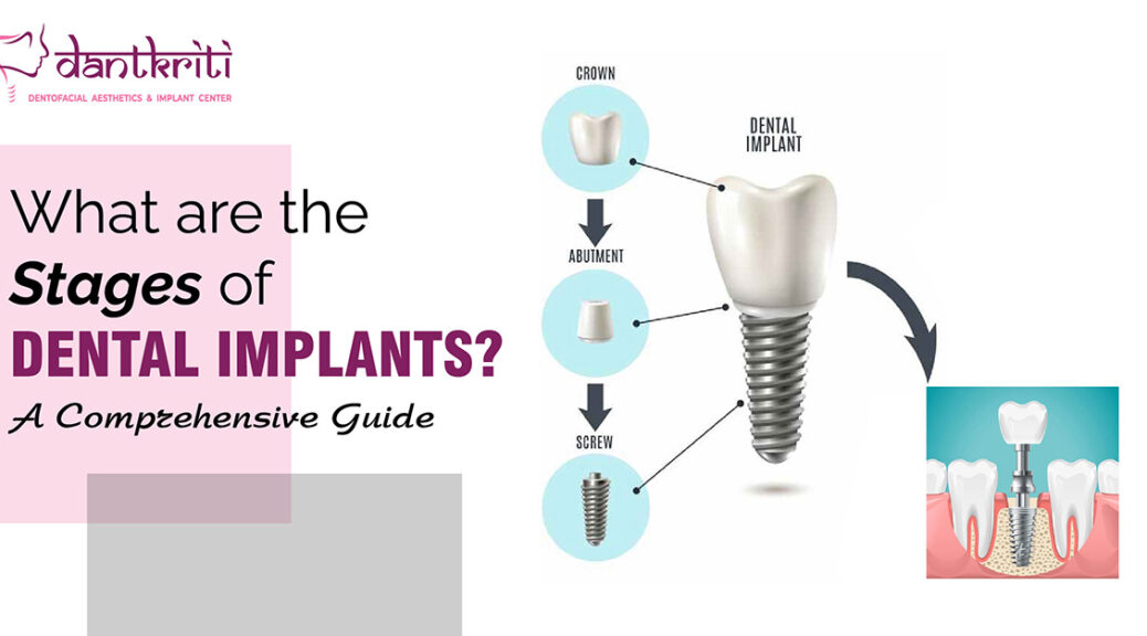 Stages of dental Implant