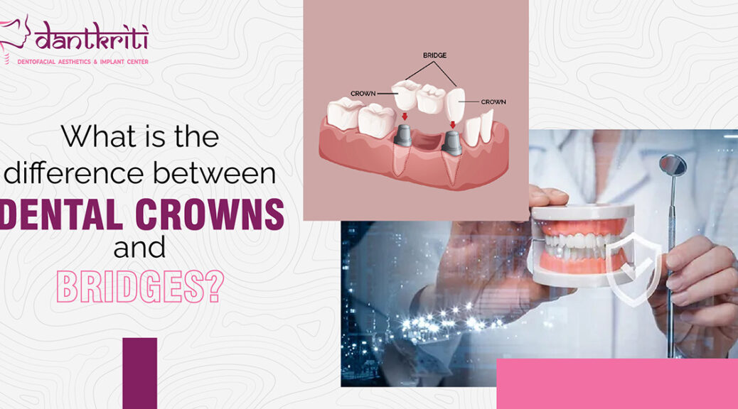Difference between dental crowns and bridges