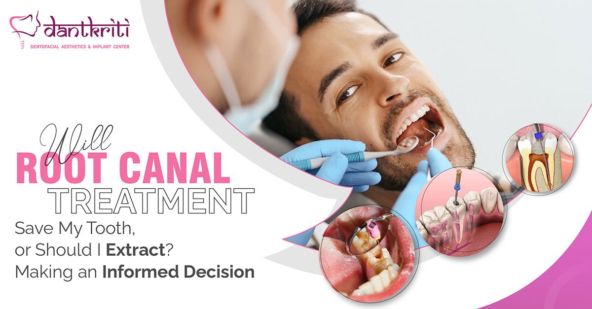 Will Root Canal Treatment Save My Tooth, Or Should I Extract? Making An 