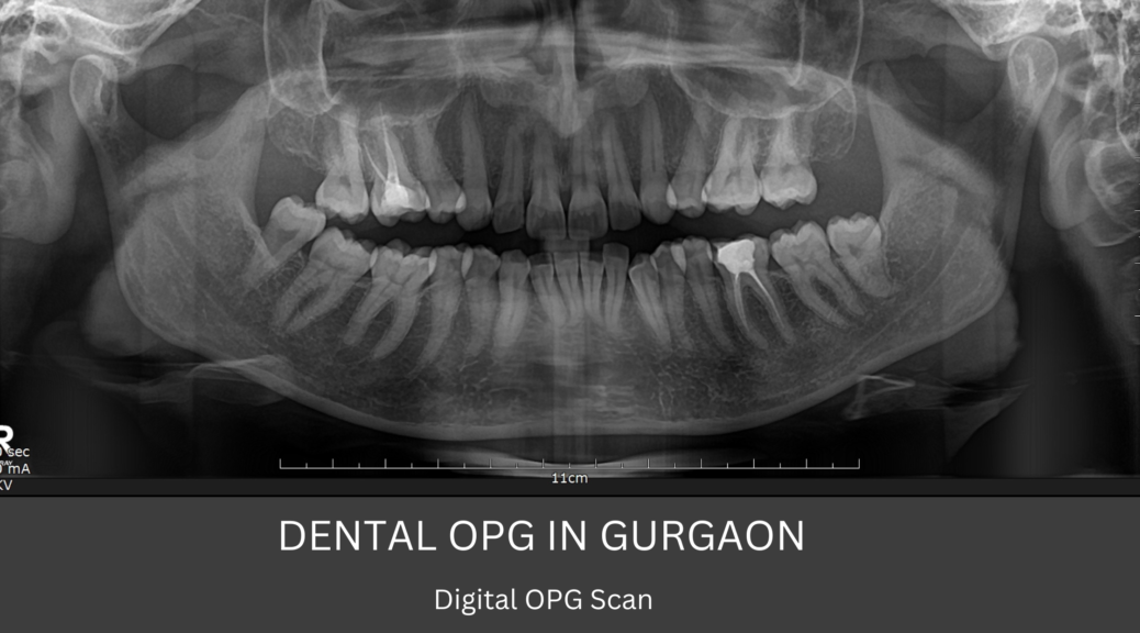 Dental OPG X-Ray in Gurgaon Digital OPG Scan