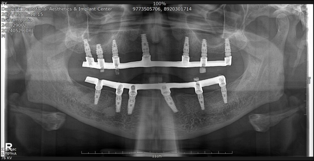 Full Mouth Dental Implants By Implant Sugeon Himanshu Gupta