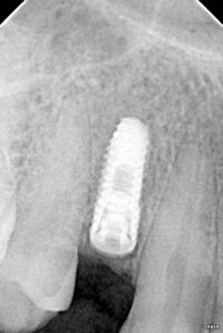 Single Tooth Dental Implant