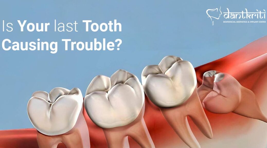 wisdom teeth removal