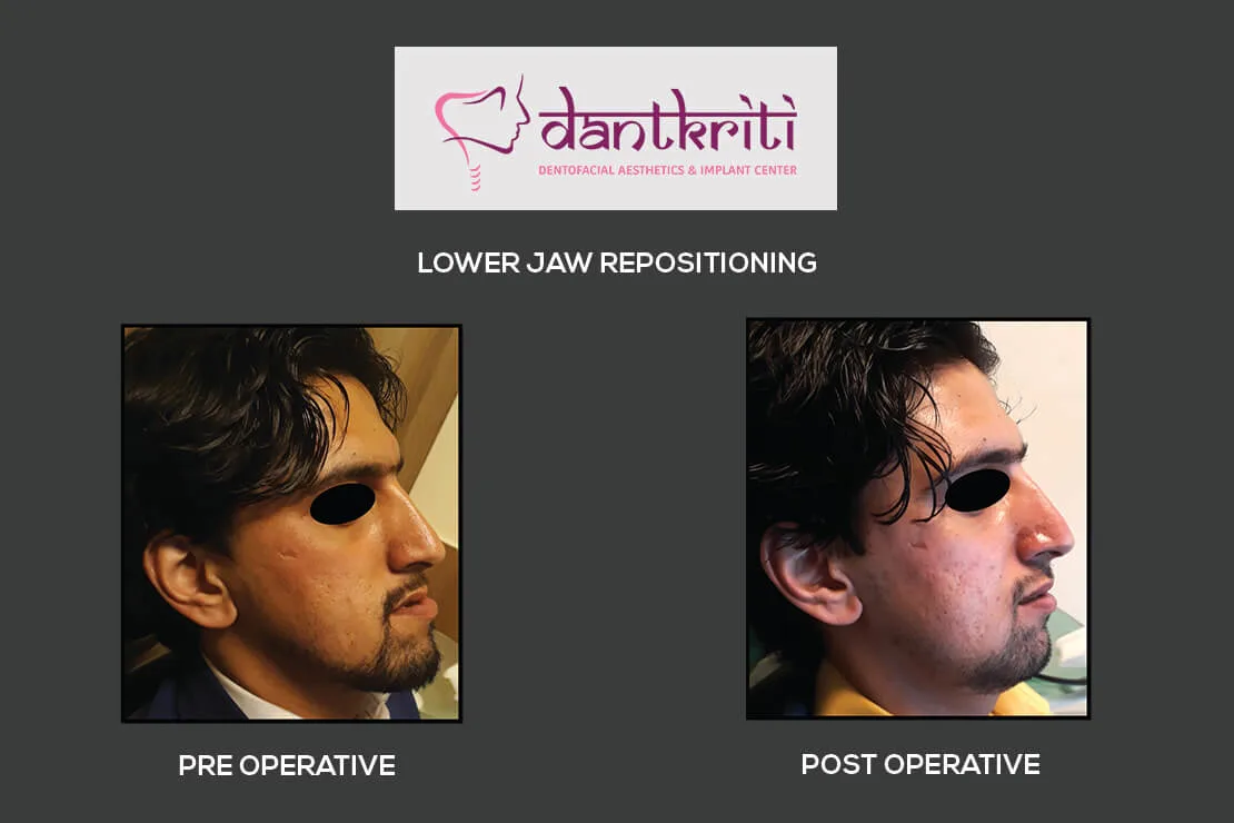 mini dental implants specialist gurgaon